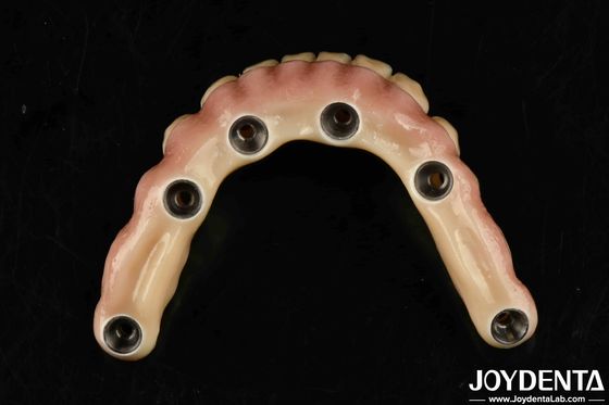Durable Dental Aesthetic Titanium Malong Hybrid Bridge For Care