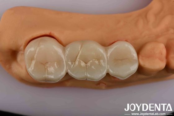 High Strength Dental Zirconia Your Ultimate Solution For Natural-looking Esthetics