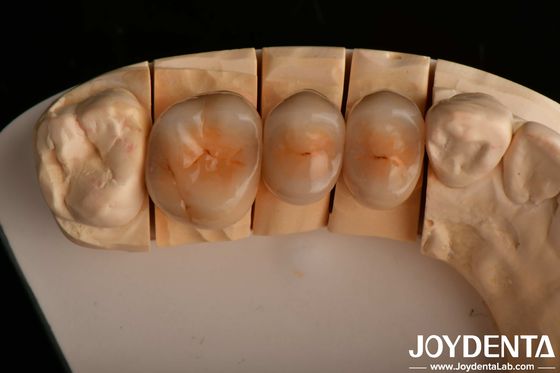 High Chipping Resistance And Natural-looking Esthetics With Multilayer Full Zirconia Technology