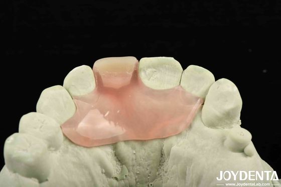 Personalized Customization Flexible Denture Finish using Tooth Arrangement Technology with Good Elasticity