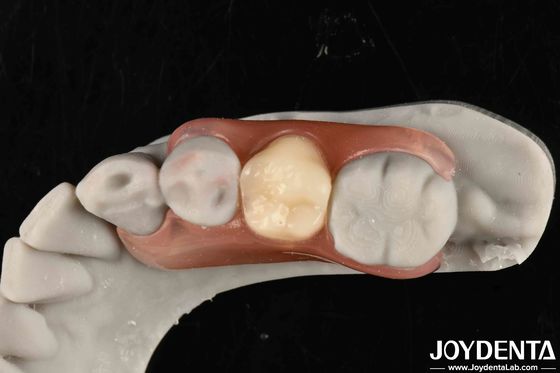 Revolutionize Your Dental Practice  Framework Set Up Teeth Finish With Elaborate Technology From Dental