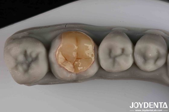 Resistant To Wear And Tear Good Transparency Low Strength Emax Inlay Onlay For Your Operational Efficiency