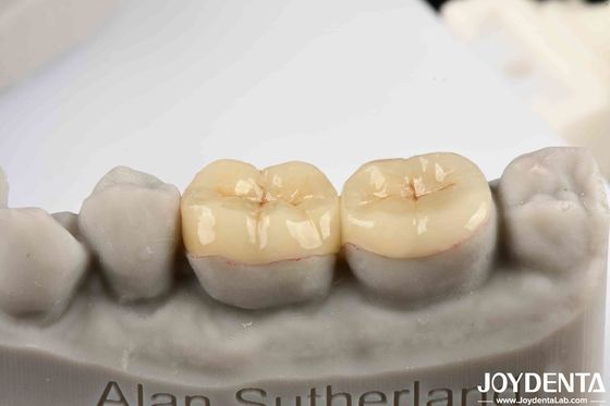 Emax Inlay Onlay Precise Fit And Hypoallergenic Biocompatibility Easy To Clean