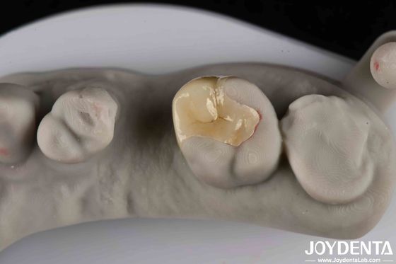 Strong Resistance To Fracture Emax Inlay Onlay Natural-looking Esthetics And Durability