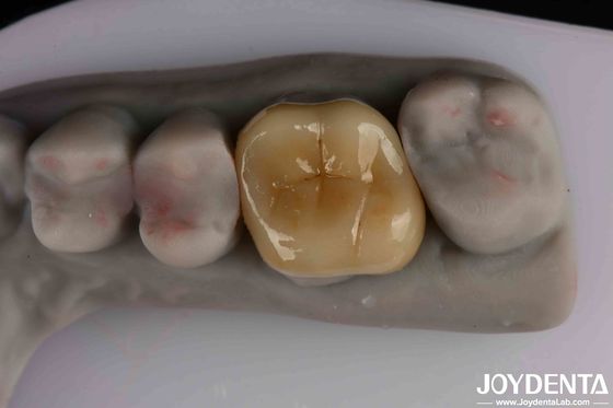 Easy To Clean And Durable Emax Inlay Onlay Resistance To Staining For Optimal Performance