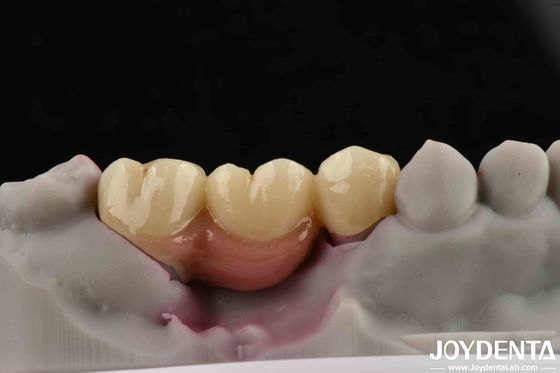 Customizable Dental Implant Supported Bridge And Crown For Dental Implants