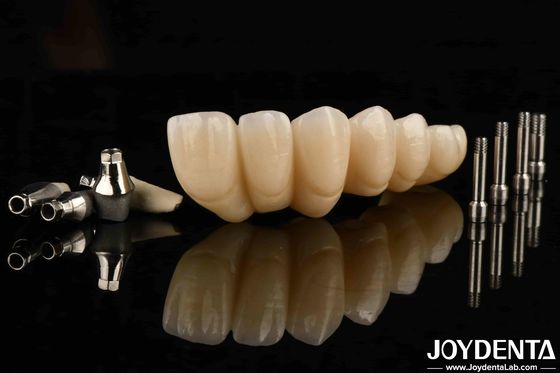 Experience  Ultimate Esthetics With Aesthetically Pleasing Dental Implant Crown And Bridge
