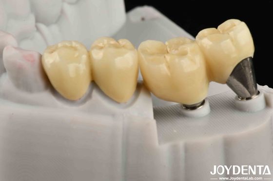 Natural-looking Implant Crown And Bridge Safe For Oral Long Lasting Performance