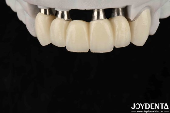 Customizable Implant Crown And Bridge For Safe Oral Biocompatibility