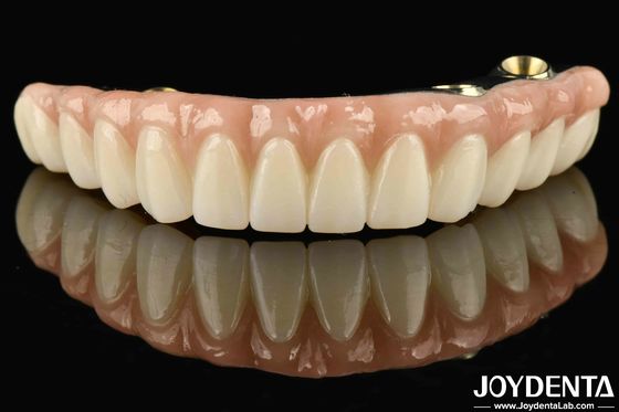 Ti-Bar Zirconia Hybrid Bridge Compatible With Natural Teeth And Gums Autobiography Restoring Chewing Function