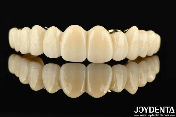 Custom-made Ti-Bar Zirconia Hybrid Bridge The Perfect Combination For Comfort And Functionality
