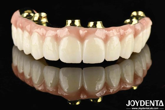 Highly Durable And Long-lasting Ti-Bar Zirconia Hybrid Bridge With Corrosion And Wear Resistance