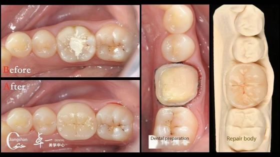 Biocompatibility And High Compatibility With Natural Teeth Restoration Dental Inlay Restorative