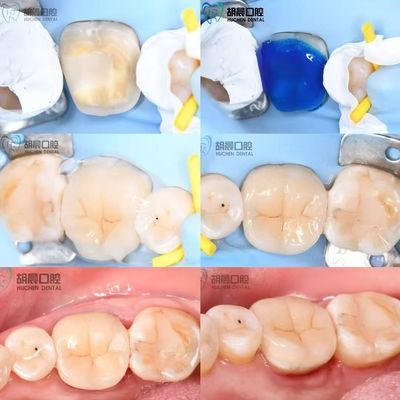 Experience The Precision Of Dental Inlay Affordable And White For Perfect Fit