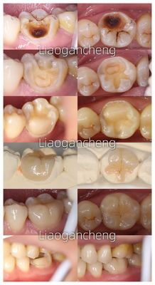 Porcelain Dental Inlay Restorative For Adults And Children Exceptional Performance
