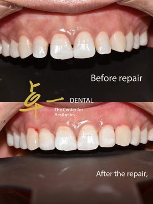Say Hello To A Flawless Smile With Cosmetic Dental Veneers No Discoloration No Preparation