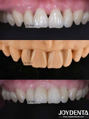 Grassshopper Veneers The Perfect Solution For Natural Translucency Dental Veneers