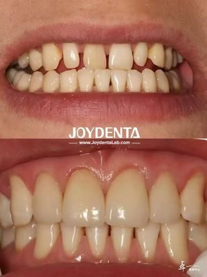 Long-lasting Dental Veneers No Discoloration Perfect For B2B Sourcing Needs And More
