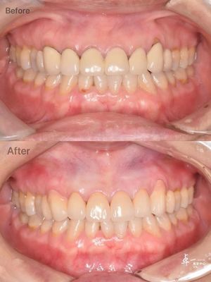 High Fracture Resistance Dental Zirconia For Safe Oral Tissue And CAD / CAM Compatibility