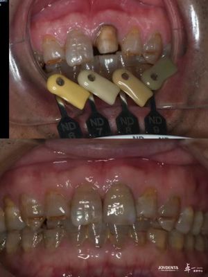 Translucency Zirconia Crowns Multilayered Gradient Technology For Optimal Translucency And Long-Term Biocompatibility