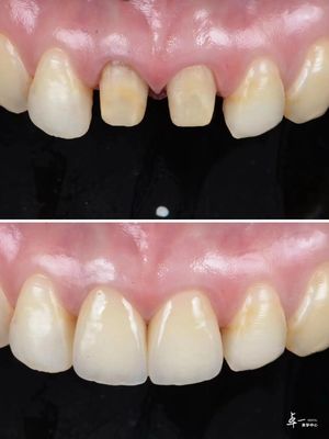 Veneers Made With High Fracture Resistance Dental Zirconia And Multilayered Gradient Technology