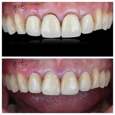 Comfortable Zirconia Dental Bridges Lightweight Natural Color Transitions For Optimal Patient Experience