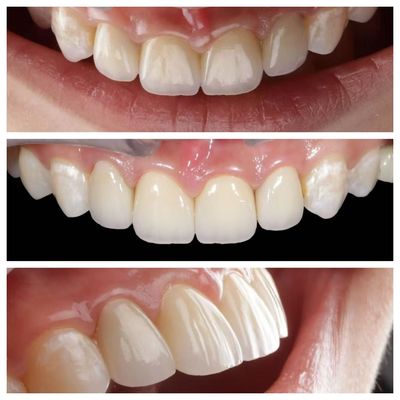 Anterior Tooth Indication Dental Veneers With 0.5mm Thickness And Perfect Permeability