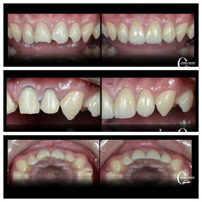 Nature Dental Veneers For  Natural And Beautiful Smile