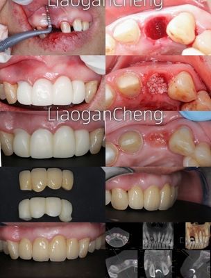 Multilayered Gradient Technology Dental Zirconia Safe And Aesthetically Pleasing For Long-term