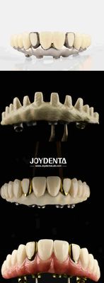 Dental Aesthetic Titanium Malong Hybrid Bridge Ultimate Solution For Dental Restorations