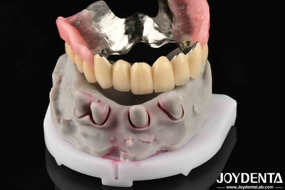 Advanced Dental Metallic Material For Supporting Mastication Needs