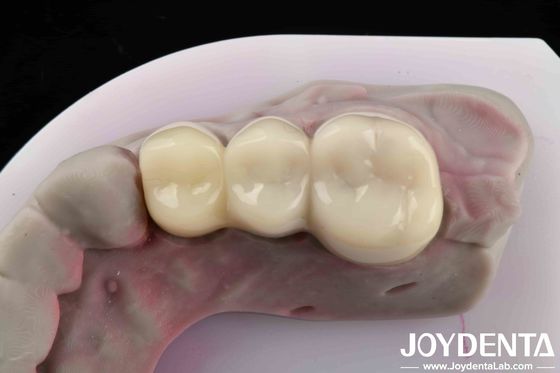 Flexural Strength 90-100 MPa Ensures Strong And Stable Temporary Restorations PMMA