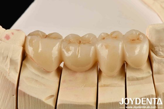 Unleash Aesthetics Of High Aesthetics Full Zirconia With White And Resistance To Thermal Shock High