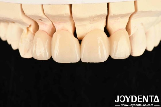 High Translucency Layered Zirconia 3 W/mK Thermal Conductivity For Exceptional Performance