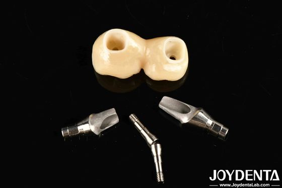 Experience Aesthetically Pleasing Results With Customizable Implant Retained Crown And Bridge
