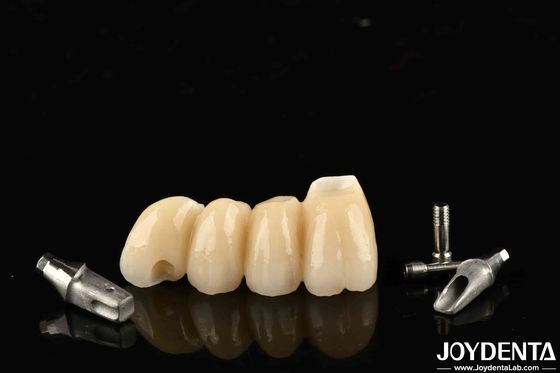 Customizable Implant Crown And Bridge In Porcelain Precision For Perfect Function