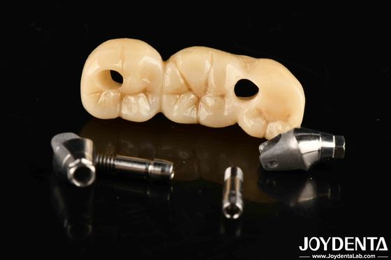 Strong Implant Crown And Bridge Perfect Solution For Aesthetically Pleasing Esthetics
