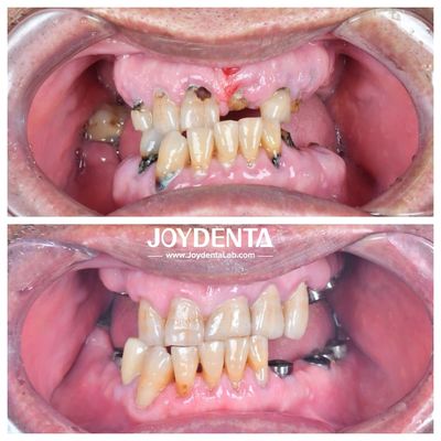 Resistant To Wear And Deformation Zirconia Dental Crowns Durable and Suitable For Posterior And Anterior Restorations
