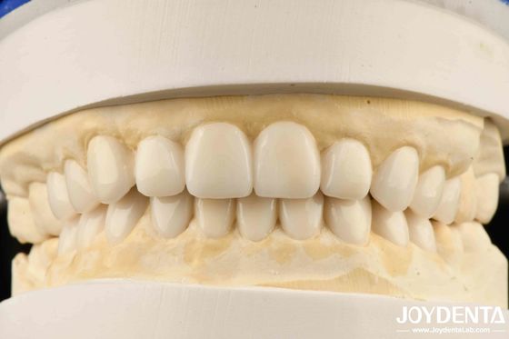 Dental Biomimetic Aesthetic Diagnostic  Wax-Up Of Veneers