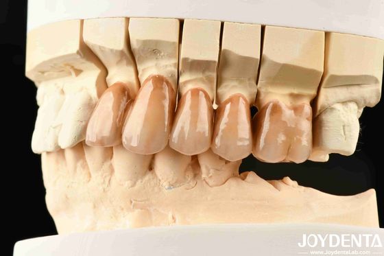 Bionic Teeth Layered Zirconia with Bionic Leaf Micro-Engraving and Multi-color Biomimetic Lamination for Advanced Light Simulation