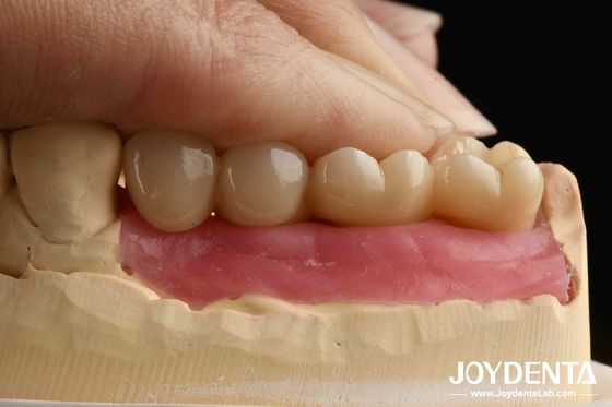 Ultra-precision processing Zirconia Implants All-Zirconium Integrated Crown