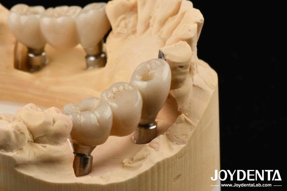 Zirconia Implants Perfect Match With Natural Teeth Zero Allergy Risk