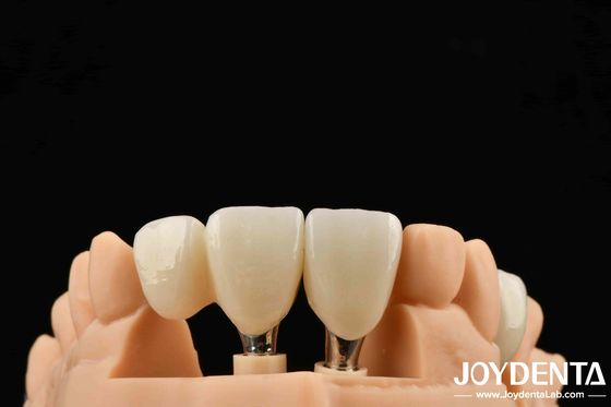 Premium Zirconia Implants for Superior Aesthetic Results Allergy-Safe Solutions and Precision Strength