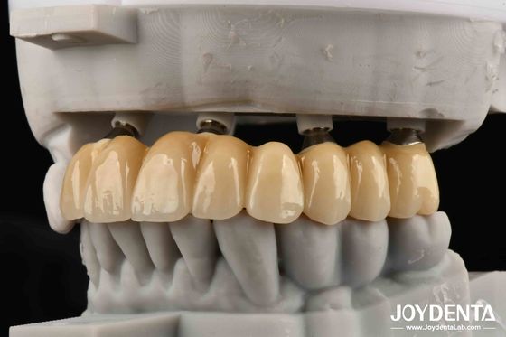 Close Friends Of Bones Foundation Of Beauty Zirconia Implants Aesthetically Supreme Choice With No Risk Of Metal Allergy