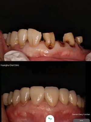 Zirconia dentures that imitate natural teeth