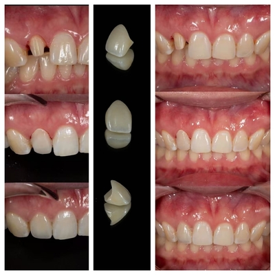 Zirconia dentures that imitate natural teeth