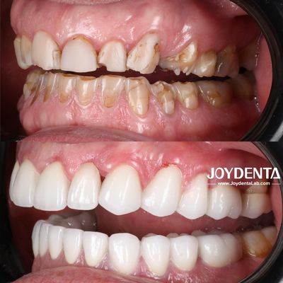 Premium Zirconia Dental Crown Solutions | JOY Dental Lab