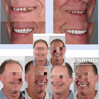 Zirconia dentures that imitate natural teeth