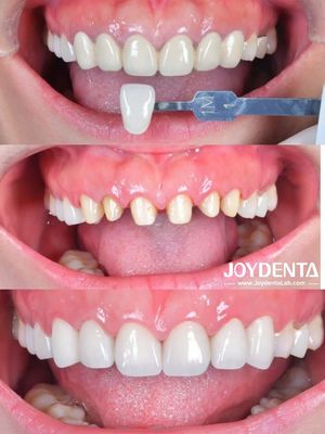 Zirconia Dental Crown Case Study | Global Lab Outsourcing - Joydentalab