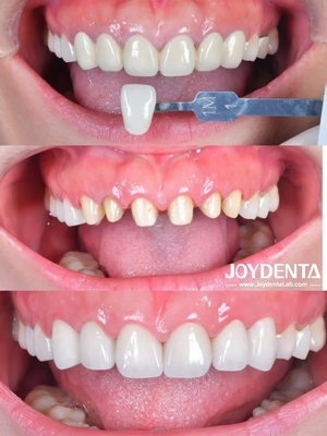 Zirconia dentures that imitate natural teeth